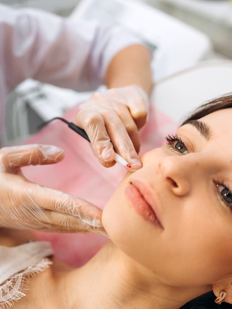 Underarm epilation results after 5-minute treatment at The Beauty Spot in Wadebridge